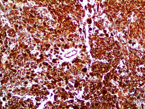 IHC of Vimentin on an FFPE Melanoma Tissue